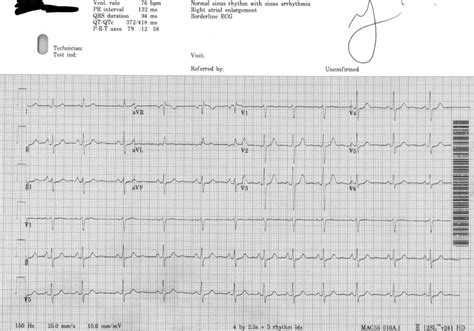 borderline ecg mayo clinic